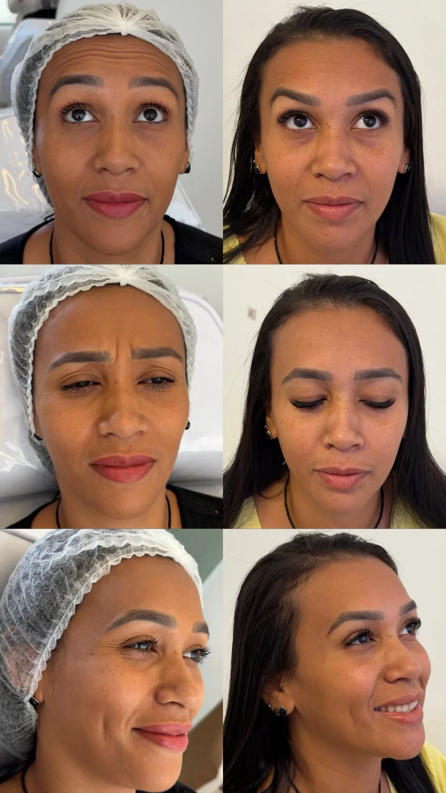 Comparativo antes e depois de aplicação de Botox na testa e região dos olhos