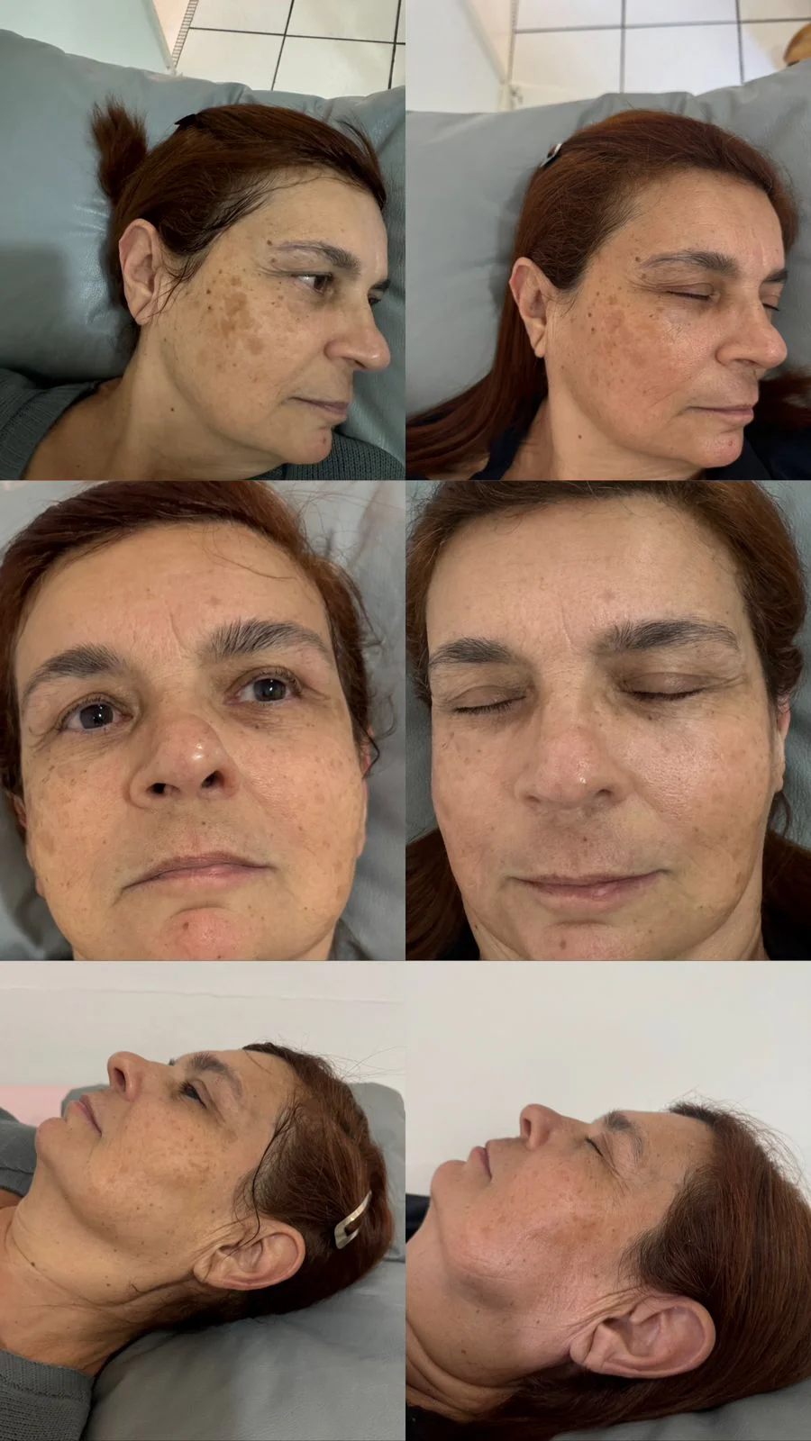 Resultado de tratamento Lavieen para renovação da pele