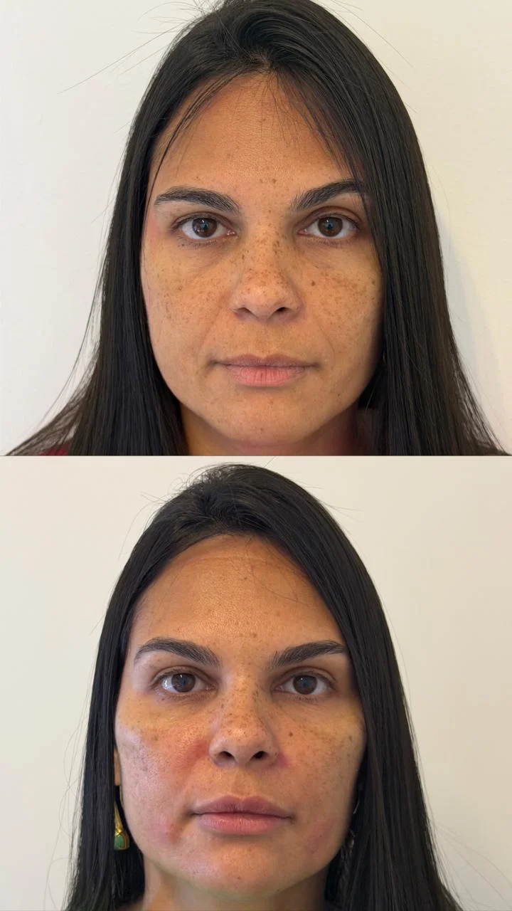 Resultado de preenchimento facial para contorno e volume