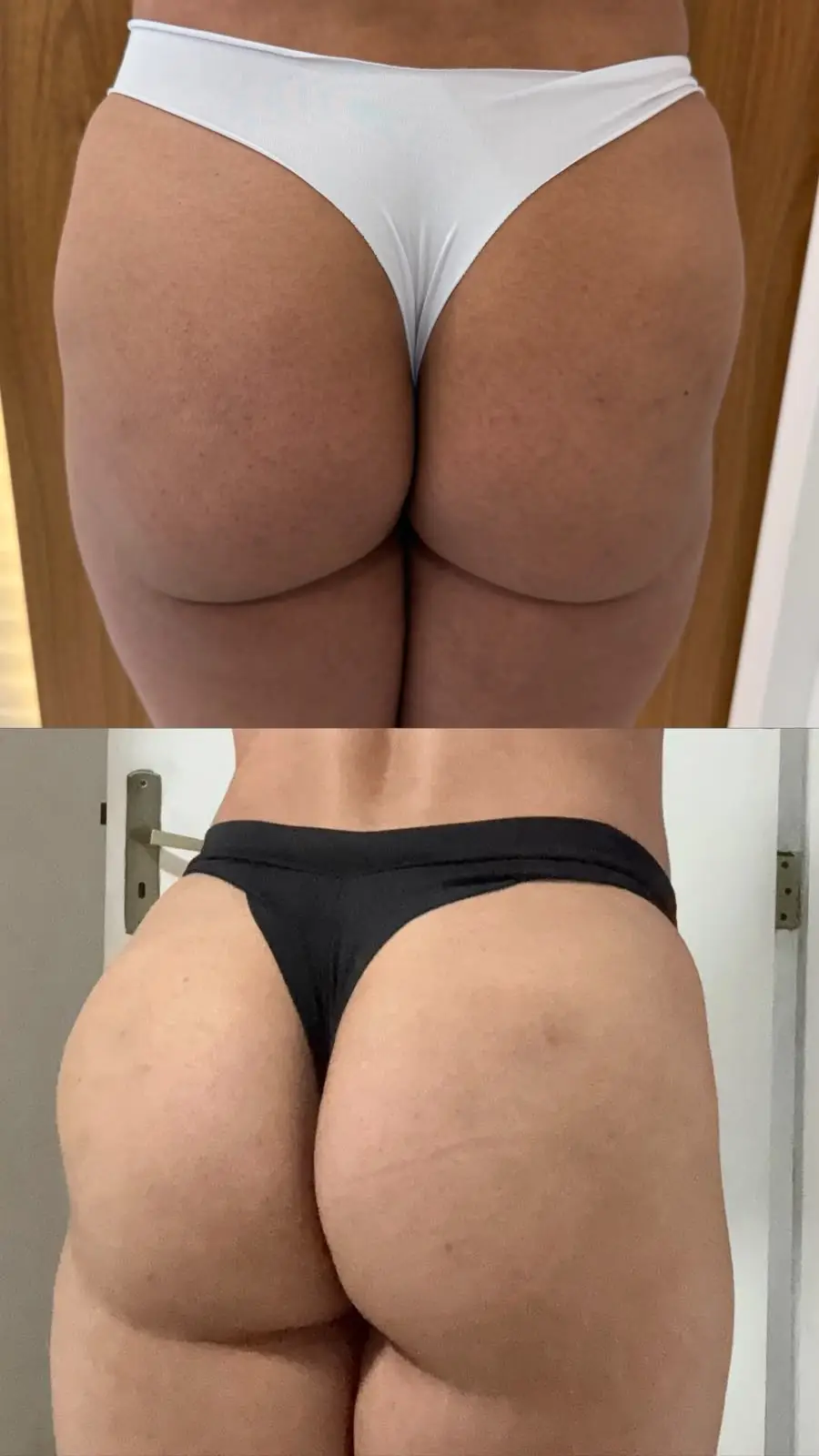 Resultado de preenchimento de glúteo antes e depois