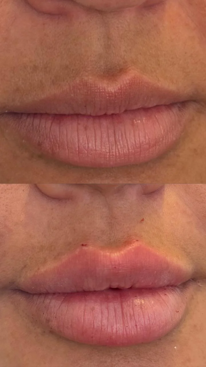 Resultado de preenchimento labial antes e depois