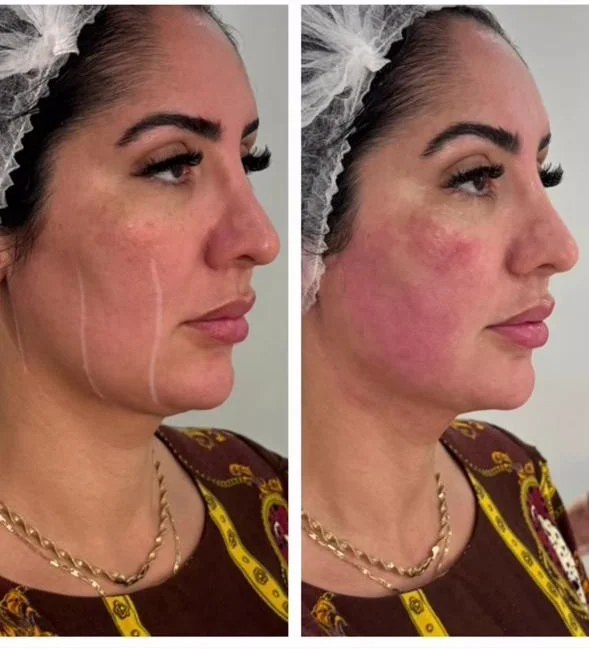 Resultado de tratamento com Ultraformer para flacidez facial