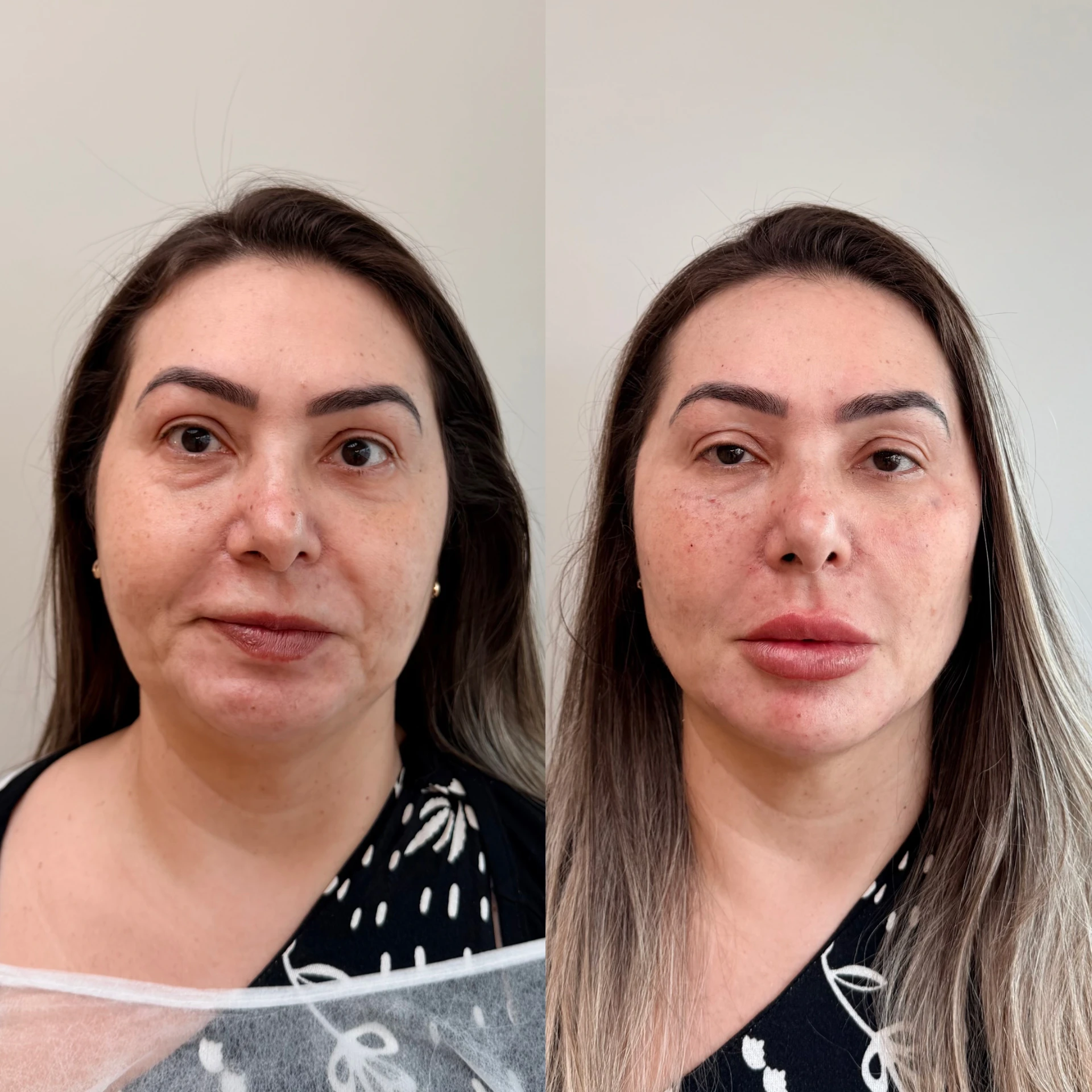 Comparativo de antes e depois de procedimento facial