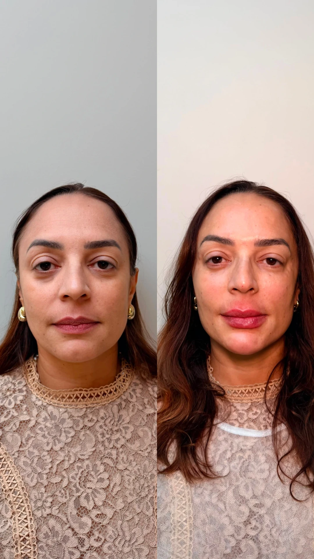 Comparativo de antes e depois de procedimento facial