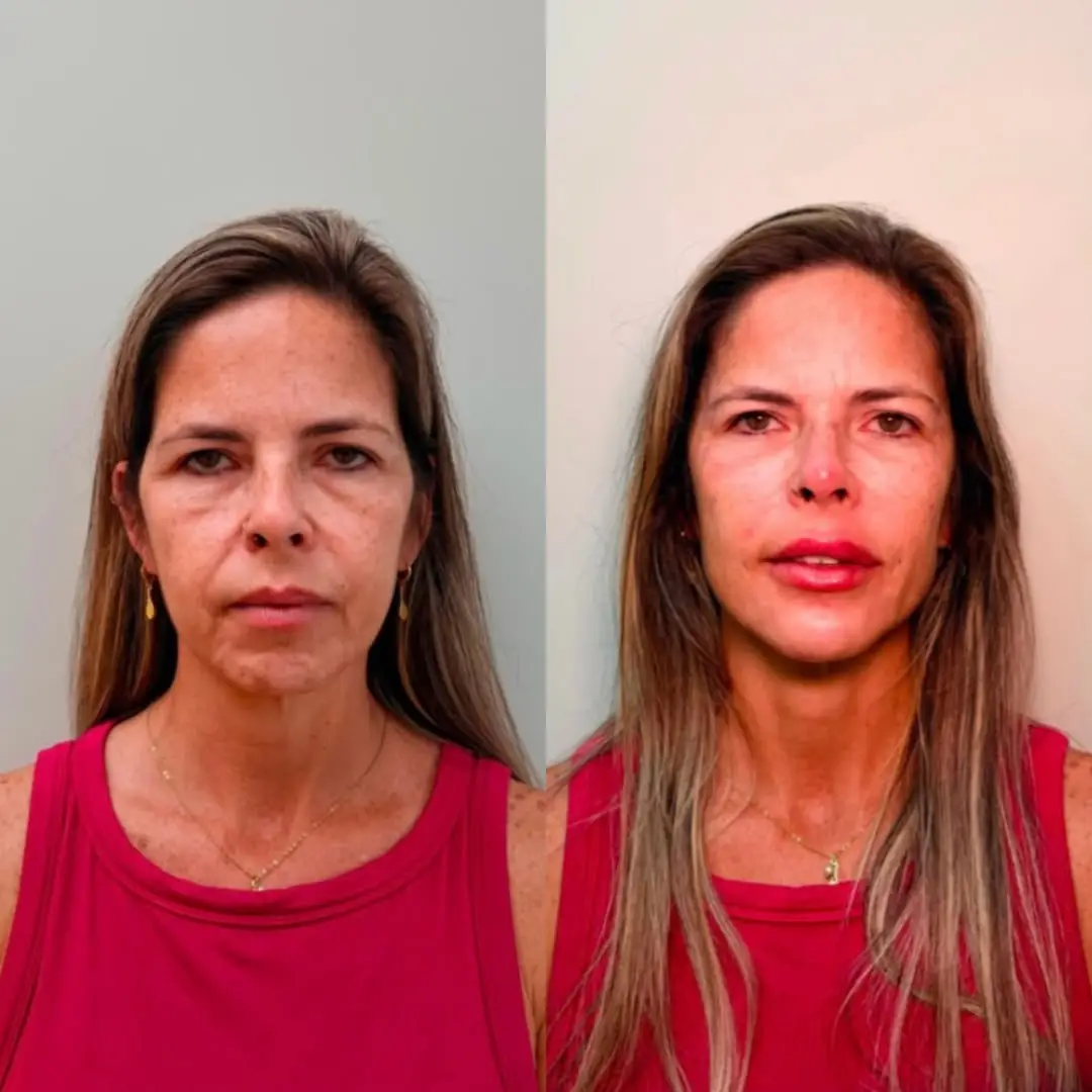 Comparativo de antes e depois de procedimento facial